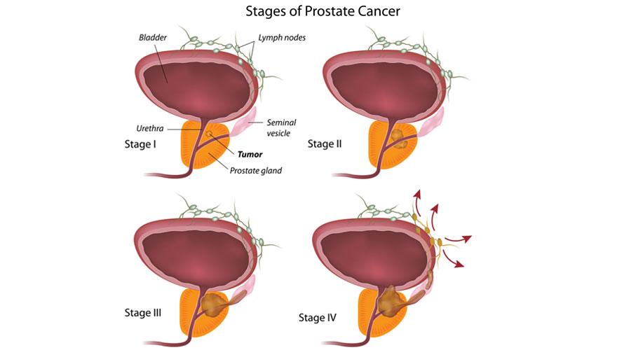 Prostate Cancer Biology Causes Stages And Treatment